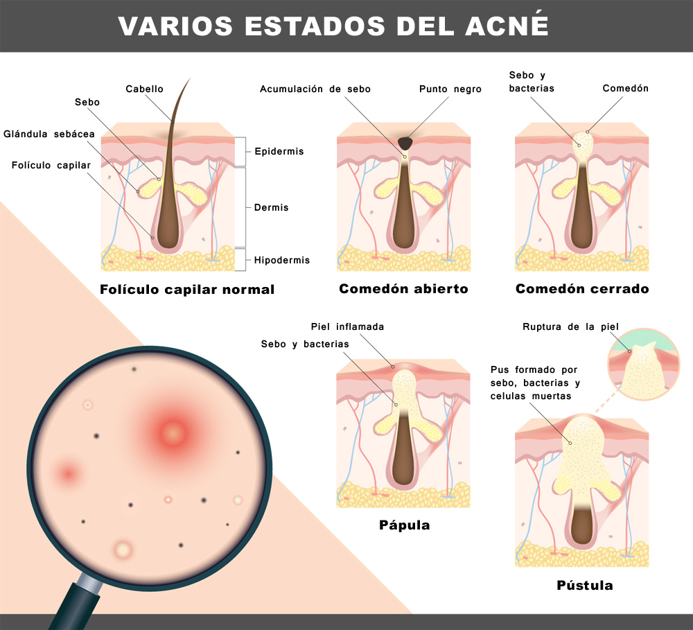 tipes-of-acne-saggital-es